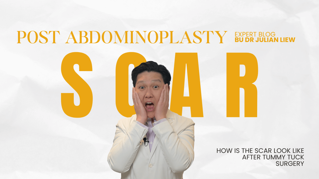 SCAR AFTER abdominoplasty